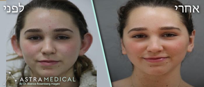 תמונת ילדה לפני ואחרי ניתוח הצמדת אוזניים