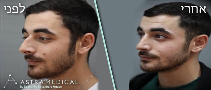 ניתוח אף לגבר - לפני ואחרי - צד