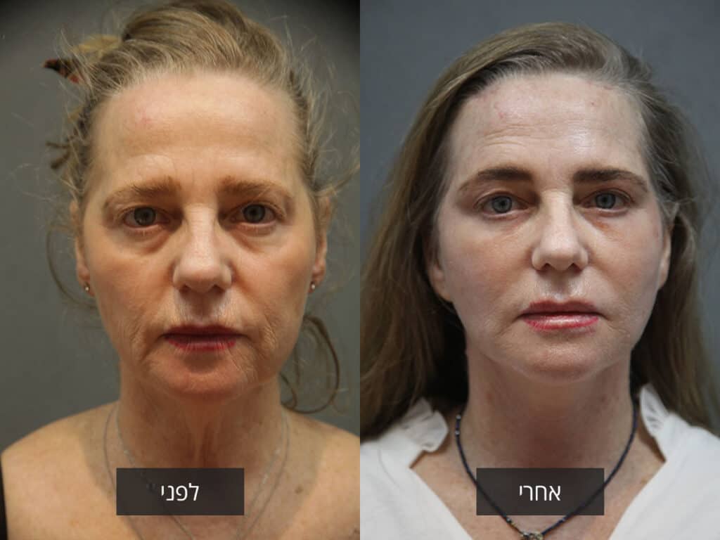 מתיחת פנים לפני ואחרי באסטרה מדיקל מרכז רפואי לניתוחים פלסטיים