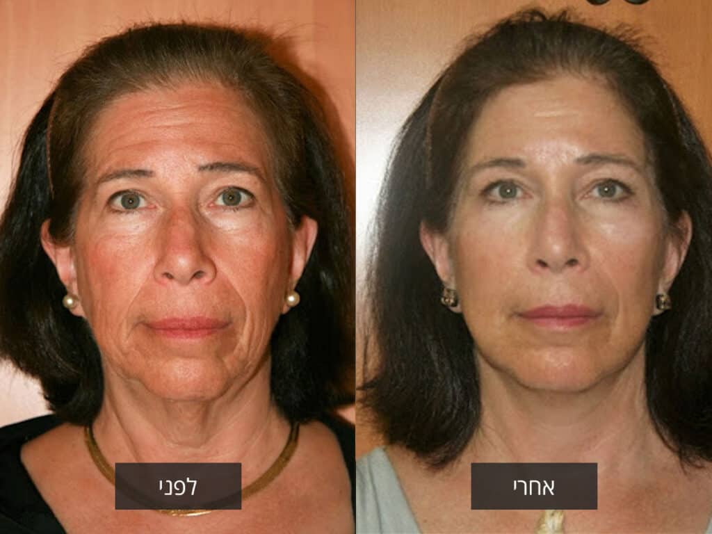 מתיחת פנים לפני ואחרי - אסטרה מדיקל - קליניקה לניתוחים פלסטיים וטיפולים אסתטיים