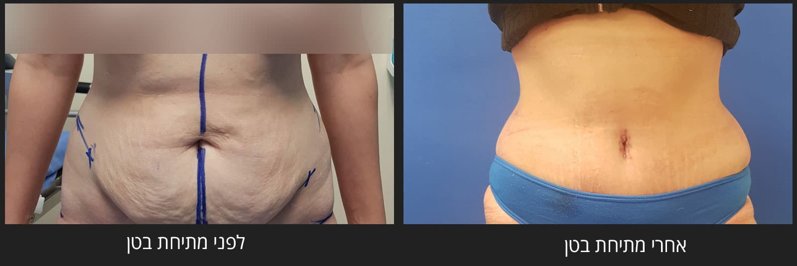 ניתוח מתיחת בטן - לפני ואחרי