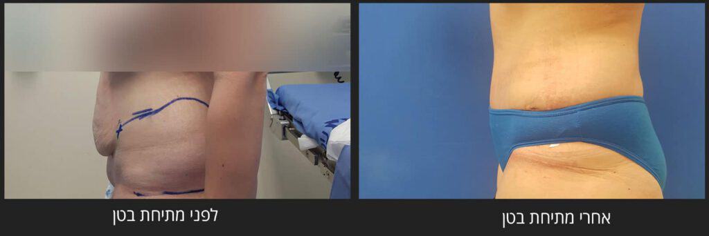 לפני ואחרי ניתוח מתיחת בטן ב-ASTRA MEDICAL