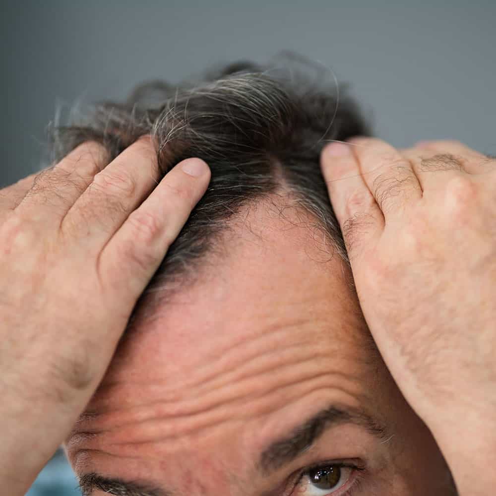 התקרחות אנדרוגנטית (התקרחות גברית או נשית) בשלבים מוקדמים עד בינוניים מגיבה היטב להזרקת שומן לקרקפת.